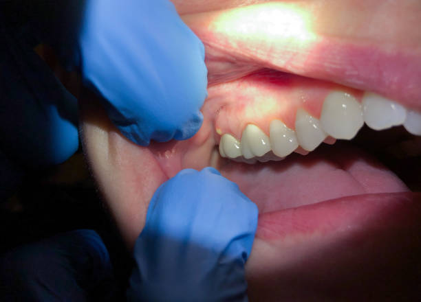 Best Emergency Tooth Extraction  in Purcell, OK