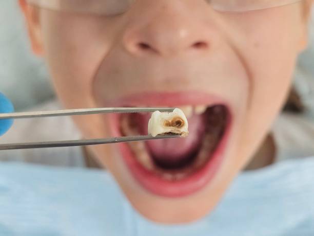 Best Teeth Whitening  in Purcell, OK